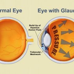 Imagem da notícia: Glaucoma atinge milhares de pessoas