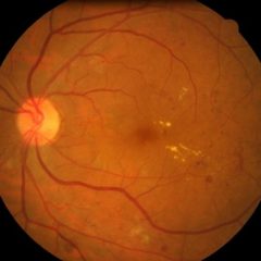 Imagem da notícia: Análise da retina pode ser fundamental para apurar risco de AVC