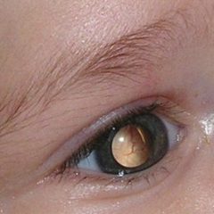 Imagem da notícia: Cancro infantil pode ser diagnosticado com fotografia