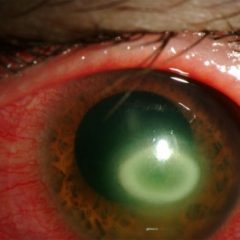 Imagem da notícia: Jovem cega por usar lentes de contacto seis meses