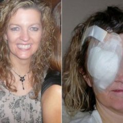 Imagem da notícia: &Oacute;culos de sol baratos contribuiram para mulher contrair cancro