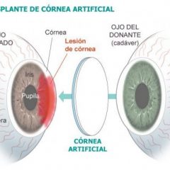 Imagem da notícia: C&oacute;rnea artificial implantada pela primeira vez em Granada