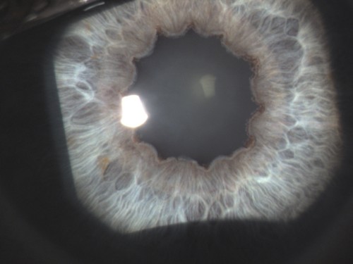 Imagem da notícia: Paramiloidose Ocular: Um caso clínico