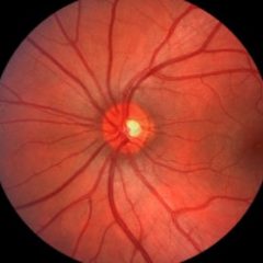 Imagem da notícia: Tecnologia ajuda a entender glaucoma