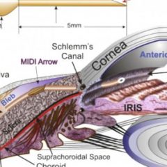 Imagem da notícia: Glaucoma: novo procedimento testado