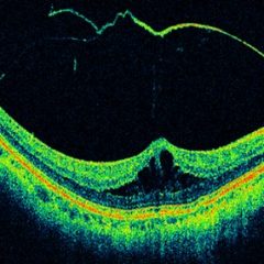 Imagem da notícia: OCT pode ser aplicada além oftalmologia