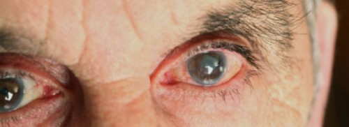 Imagem da notícia: Estamos na Semana Mundial do Glaucoma