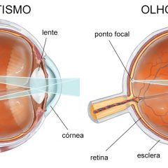 Imagem da notícia: Alcon apresenta tecnologias para gestão de astigmatismo na cirurgia da catarata