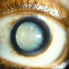 Imagem da notícia: Ultrassons para diagnosticar cataratas