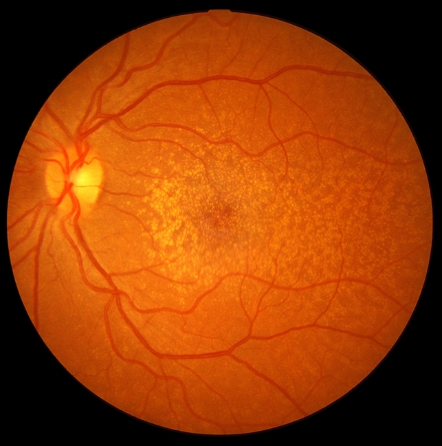 Imagem da notícia: Mais de 30% dos espanhóis acima dos 50 anos tem problemas na retina