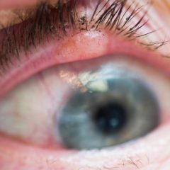 Imagem da notícia: Novo estudo correlaciona melanoma e cancro ocular