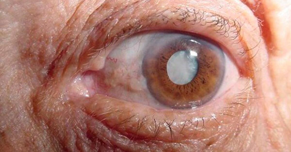Imagem da notícia: Colírio que “derrete” cataratas nos olhos?