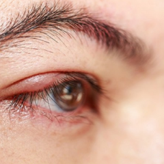 Imagem da notícia: Doença de Fabry pode afetar olhos