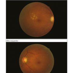 Imagem da notícia: RetmarkerAMD referenciado pelo jornal Eye