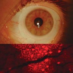 Imagem da notícia: Que impacto poderão ter as lentes esclerais na morfologia das células conjuntivais?