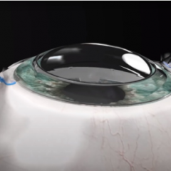 Imagem da notícia: Córnea sintética ajuda cego a voltar a ver