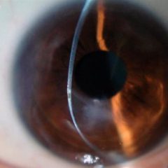 Imagem da notícia: Ceratocone é a principal causa de transplante da córnea em jovens