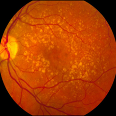 Imagem da notícia: Estudo da Universidade de Maryland identifica novo mecanismo que pode causar DMRI