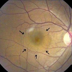 Imagem da notícia: Estudo confirma melhoria da função visual em pacientes tratados com “Terapia Fotodinâmica”