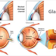 Imagem da notícia: Investigação de Birmingham abre caminho a uma nova terapia anti fibrótica para o glaucoma