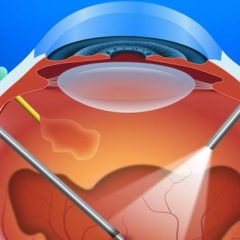 Imagem da notícia: Hospital Internacional dos Açores realiza primeira cirurgia Vitrectomia