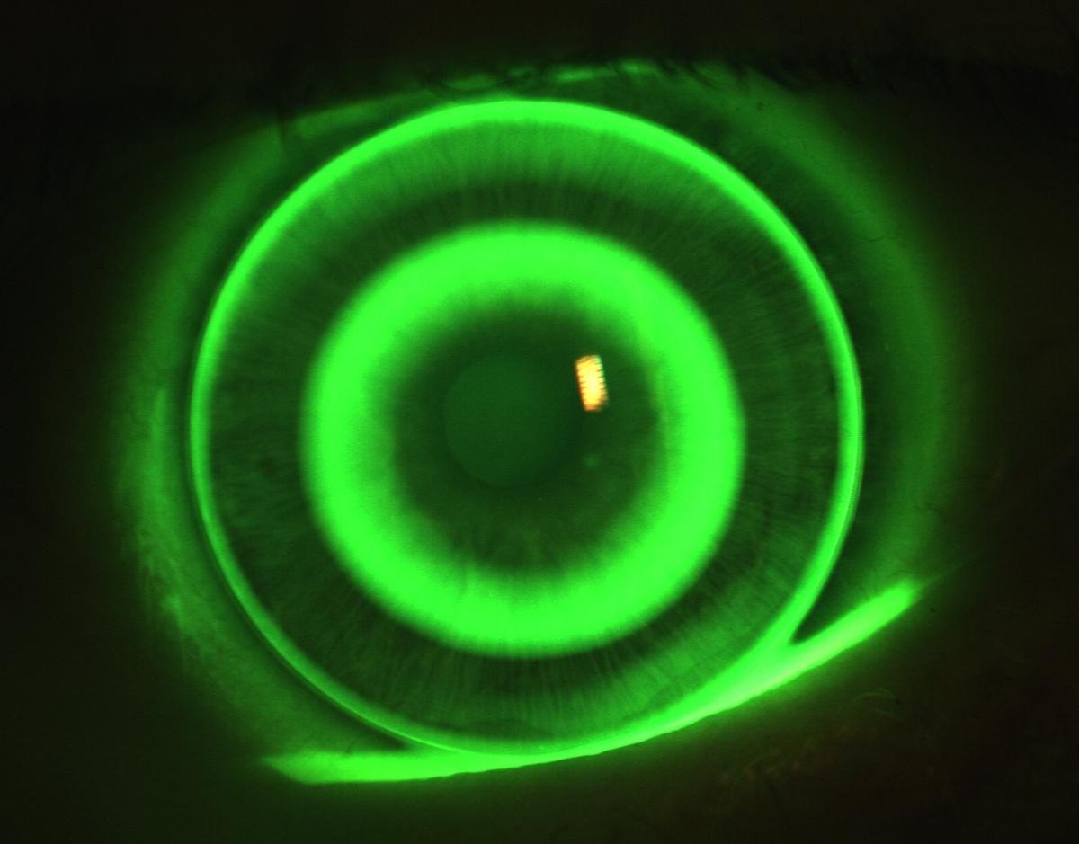 Imagem da notícia: UMinho inicia estudo de controlo da miopia com lentes Orto-K