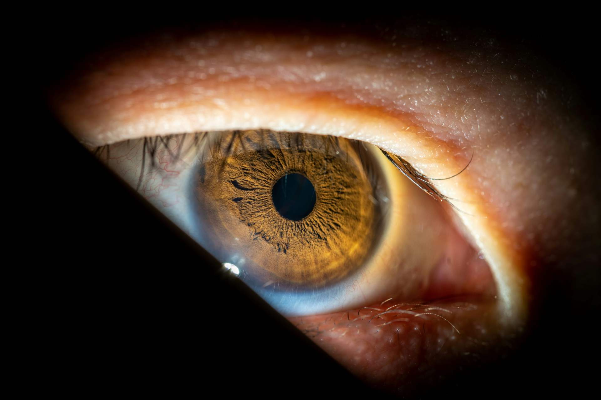 Imagem da notícia: Uveíte pesa na qualidade de vida visual, sugere estudo